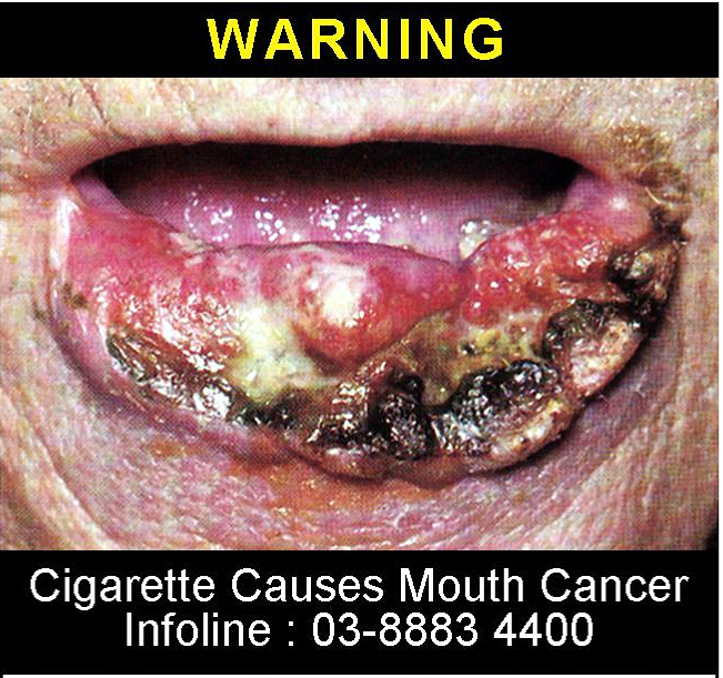 Malaysia 2008 Health Effects Mouth - mouth cancer, gross (back)